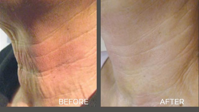 Body Skin Tightening Ventura CA – NedaMedica Laser Skin Care